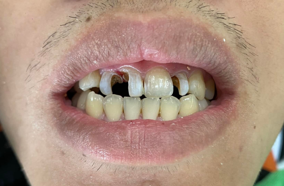 TRÁM RĂNG THẨM MỸ 