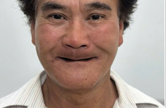 HÀM GIẢ THÁO LẮP
