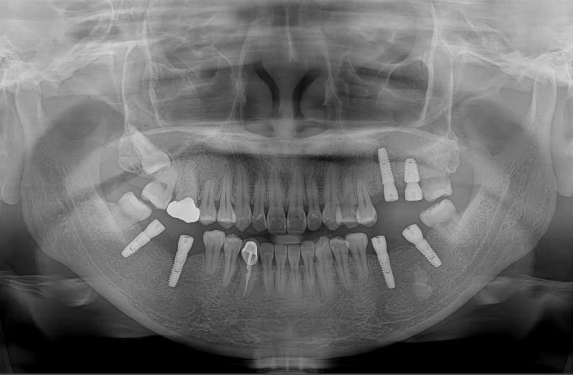 CẤY GHÉP IMPLANT