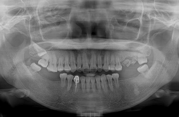 CẤY GHÉP IMPLANT