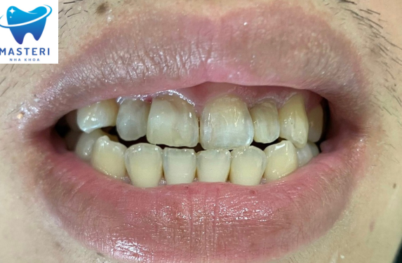 TRÁM RĂNG THẨM MỸ 