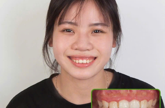 ĐIỀU TRỊ CƯỜI HỞ LỢI 