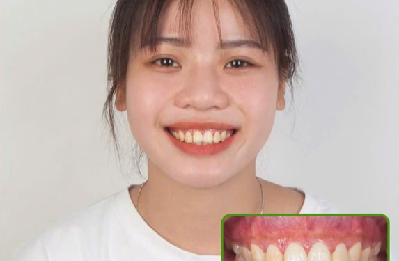ĐIỀU TRỊ CƯỜI HỞ LỢI 