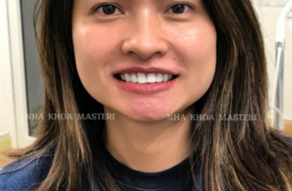 TẨY TRẮNG 