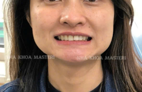 TẨY TRẮNG 