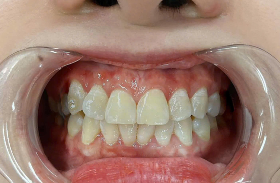 BỌC RĂNG SỨ THẨM MỸ 