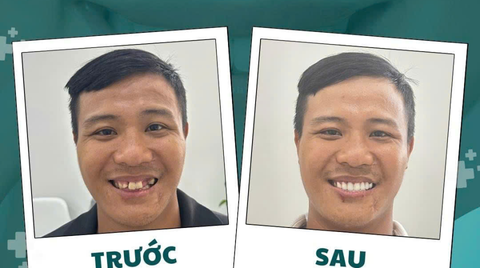 HÌNH ẢNH THỰC TẾ KHÁCH HÀNG SỬ DỤNG DỊCH VỤ RĂNG SỨ