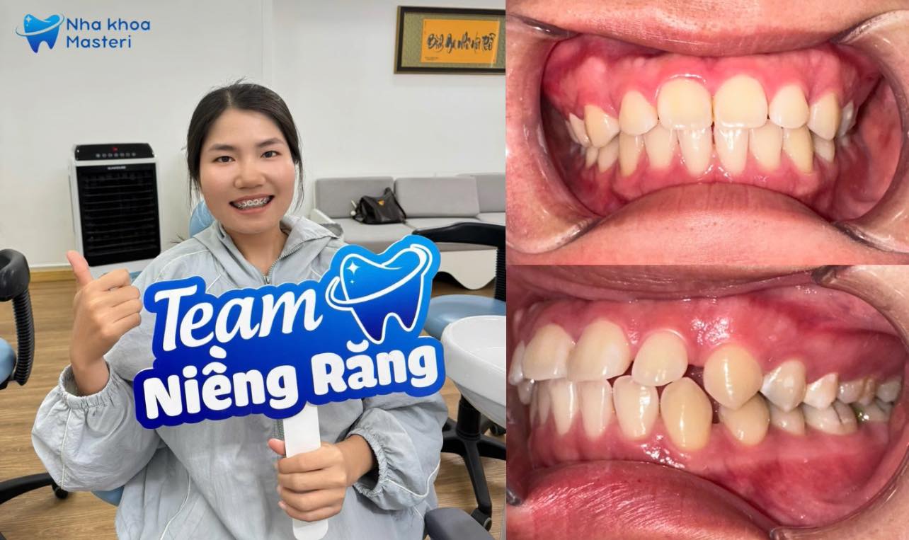 Niềng Răng Thẩm Mỹ Tại Thủ Đức