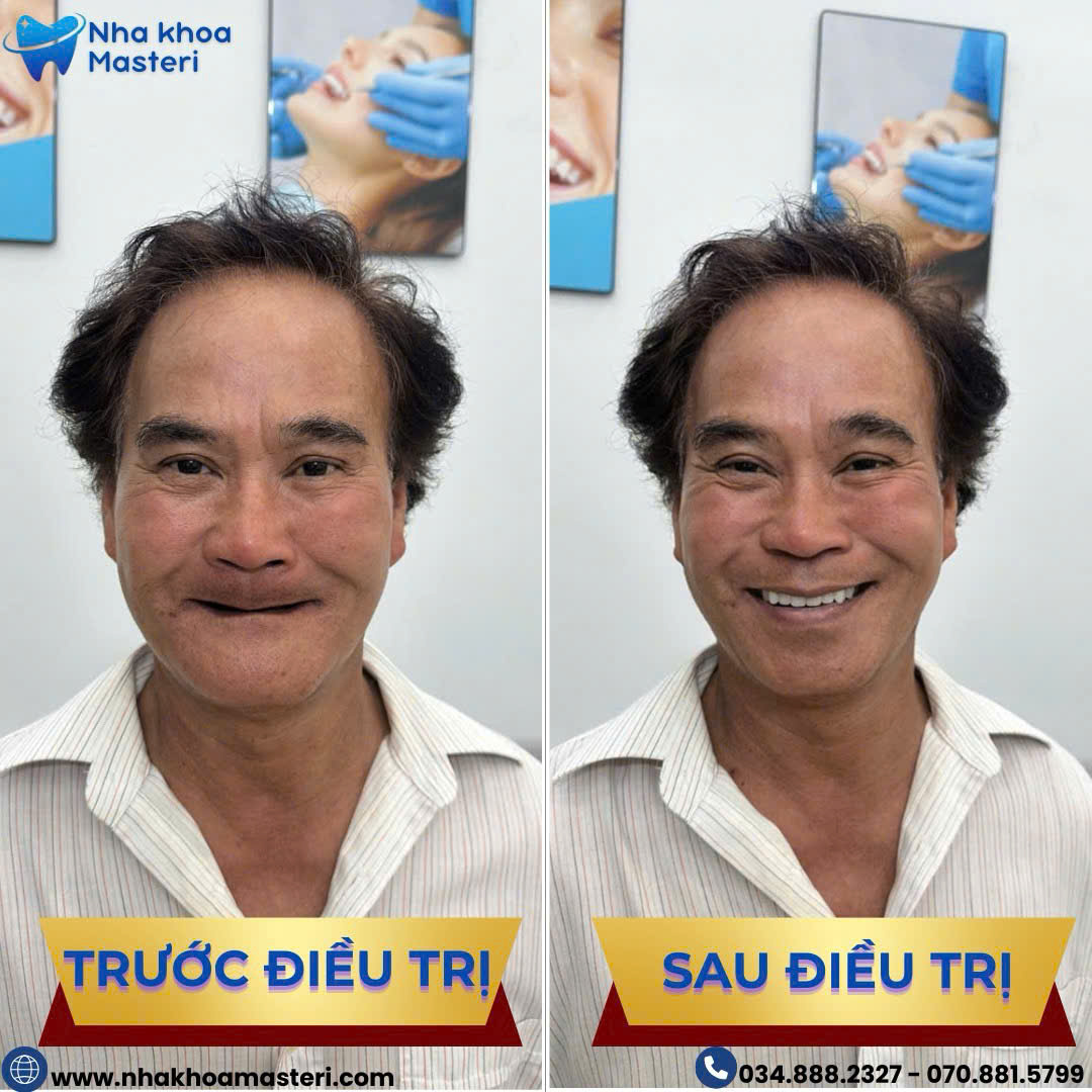 Hàm tháo giả tháo lắp phù hợp với những người lớn tuổi