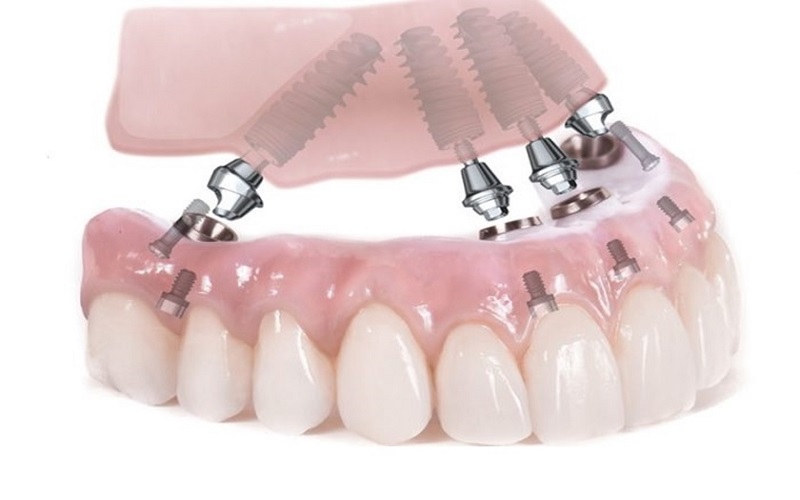 Hàm giả tháo lắp trên trụ implant